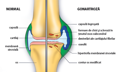 tratamentul artrozei articulației acromioclaviculare